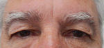 Blepharoplasty