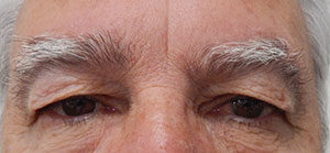 Blepharoplasty