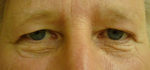 Blepharoplasty