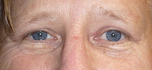 Blepharoplasty