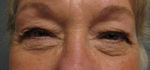Blepharoplasty