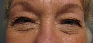 Blepharoplasty