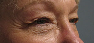 Blepharoplasty