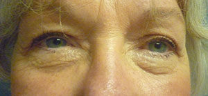 Blepharoplasty