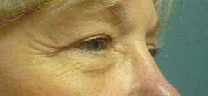 Blepharoplasty