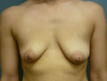 Breast Augmentation