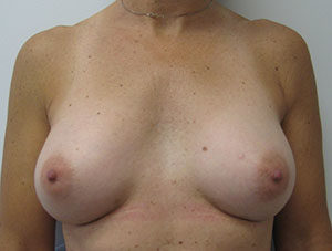 Breast Augmentation
