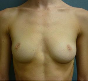 Breast Augmentation