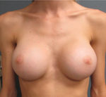 Breast Augmentation