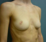 Breast Augmentation