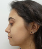 Rhinoplasty