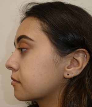 Rhinoplasty