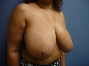 Breast Reduction