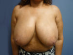 Breast Reduction