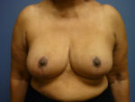 Breast Reduction