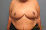 Breast Reduction