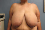 Breast Reduction