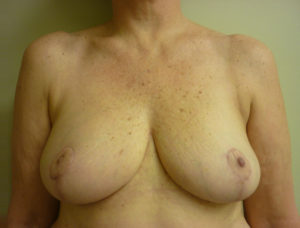 Breast Reduction