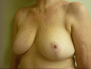 Breast Reduction