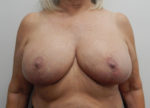 Breast Reduction