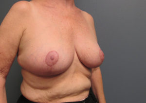 Breast Reduction