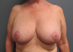 Breast Reduction