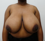 Breast Reduction