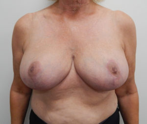 Breast Reduction