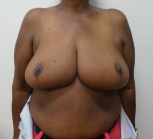 Breast Reduction