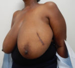 Breast Reduction