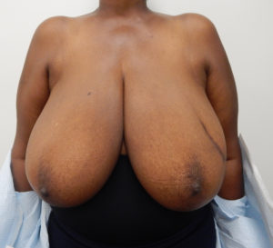 Breast Reduction