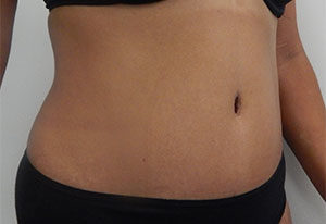 Abdominoplasty