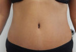 Abdominoplasty