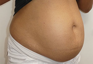 Abdominoplasty