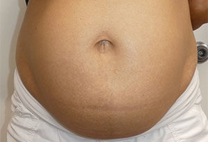 Abdominoplasty