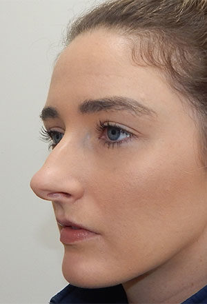 Rhinoplasty