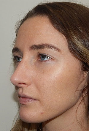 Rhinoplasty