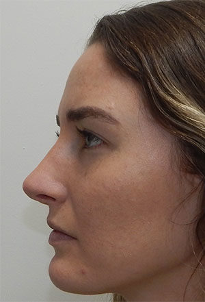 Rhinoplasty