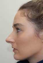 Rhinoplasty