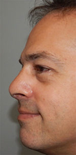 Rhinoplasty