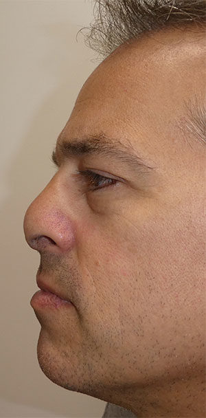 Rhinoplasty