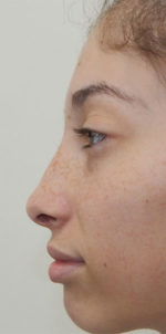 Rhinoplasty