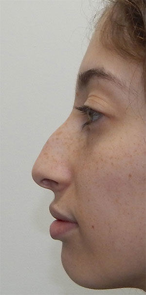 Rhinoplasty