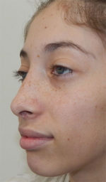 Rhinoplasty