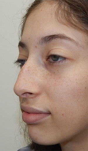 Rhinoplasty